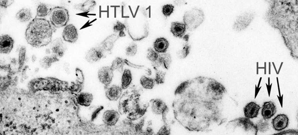 HIV AIDS and HTLV1 viruses under electron microscope
